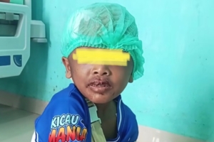 Sadis! Dua Bocah di Sidikalang Dairi Disiksa Bibinya Sendiri, 1 Korban Dirujuk ke Medan